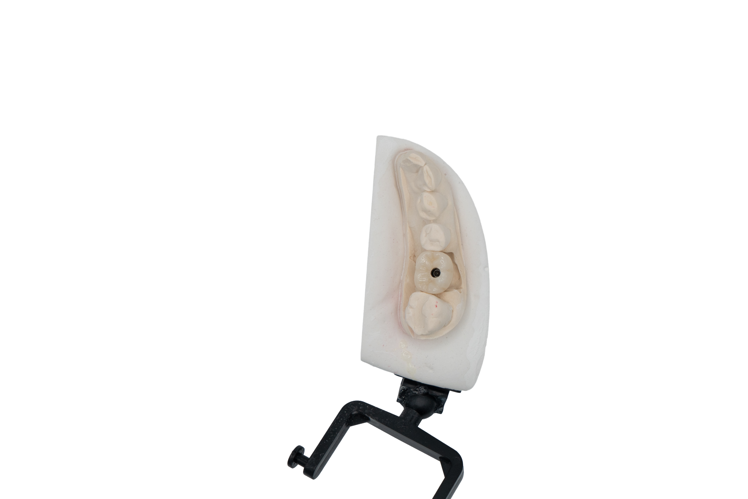 Implant Crown