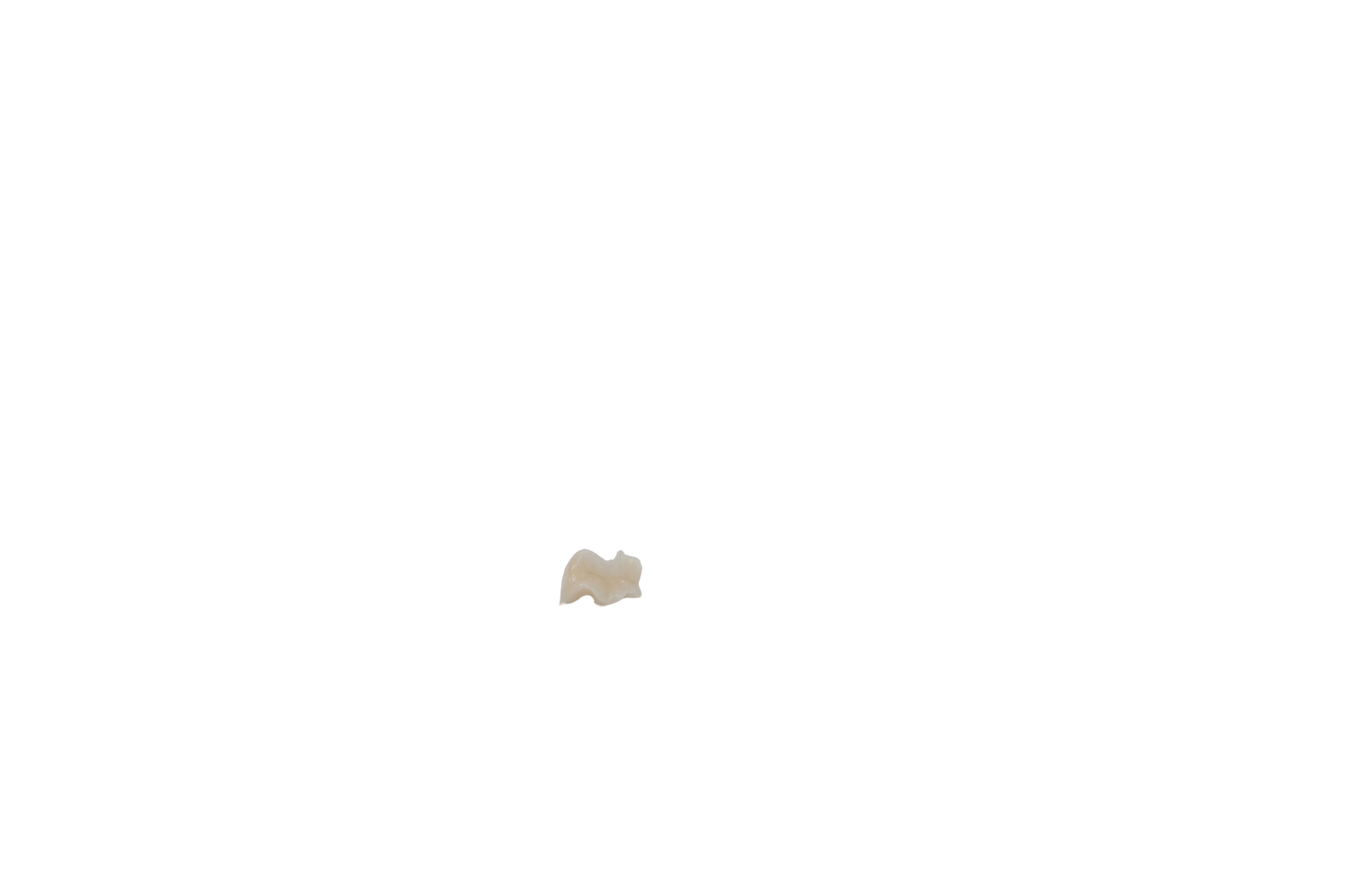 Inlay/Onlay Crown